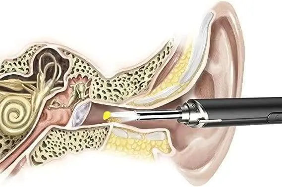 Removedor de Cera de Ouvido NE3 - Limpeza segura e eficaz